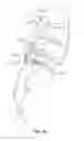 Fig. 08 - LUMBAR-SACRAL IMPLANT