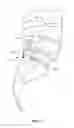 Fig. 11 - LUMBAR-SACRAL IMPLANT ALLOWING VARIABLE ANGLE FIXATION