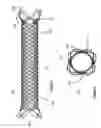Fig. 02 - Stent