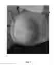 Fig. 02 - Methods of decreasing incisional hernia formation and acute wound failure in obese patients by administering basic fibroblast growth factor
