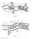Fig. 07 - DETACHABLE EMBOLIZATION COIL SLEEVE