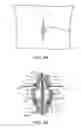 Fig. 06 - Device and accessories for limiting flexion