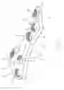 Fig. 02 - Apparatus for the constant-angle fixation and compression of a fracture or osteotomy of a bone