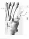 Fig. 02 - INTRAOSSEOUS FIXATION ASSEMBLY FOR AN OSTEOTOMY AND METHOD OF USE