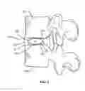 Fig. 02 - SPINAL IMPLANT WITH ATTACHABLE BONE SECURING COMPONET