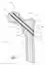 Fig. 02 - Distal bone anchors for bone fixation with secondary compression