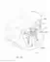 Fig. 58 - System and method for percutaneous mitral valve repair