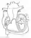 Fig. 01 - Sensor assembly tethered within catheter wall