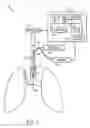 Fig. 02 - Multiple channel tracheal tube placement device and technique for using the same