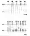 Fig. 04 - Arrhythmia detection based on active muscle noise detection
