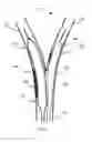 Fig. 02 - Method and a balloon catheter assembly for treating bifurcation lesions