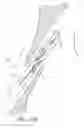 Fig. 14 - Suturing devices and methods for closing a patent foramen ovale