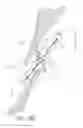 Fig. 15 - Suturing devices and methods for closing a patent foramen ovale