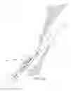 Fig. 31 - Suturing devices and methods for closing a patent foramen ovale