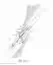 Fig. 33 - Suturing devices and methods for closing a patent foramen ovale