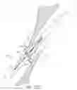 Fig. 34 - Suturing devices and methods for closing a patent foramen ovale