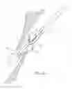 Fig. 40 - Suturing devices and methods for closing a patent foramen ovale