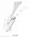 Fig. 64 - Suturing devices and methods for closing a patent foramen ovale