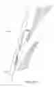 Fig. 98 - Suturing devices and methods for closing a patent foramen ovale