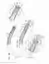 Fig. 08 - Tissue anchor for annuloplasty device