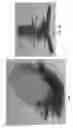 Fig. 35 - METHOD AND APPARATUS FOR TREATING VARICOSE VEINS