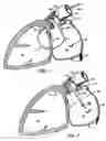Fig. 02 - BARRIER DEVICE FOR OSTIUM OF LEFT ATRIAL APPENDAGE