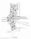 Fig. 09 - Use of bioabsorbable material for anterior extradiscal correction of thoracolumbar pathologies
