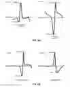 Fig. 07 - Techniques for determining morphological stability of cardiac cycles
