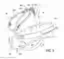 Fig. 06 - Methods, Devices, Kits and Systems for Defunctionalizing the Cystic Duct