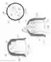 Fig. 17 - Needle for bloodless IV