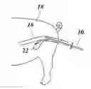 Fig. 01 - TOOL FOR MANIPULATING AN OBJECT IN A BODY CAVITY