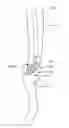 Fig. 01 - Method and apparatus for gastrointestinal tract ablation to achieve loss of persistent and/or recurrent excess body weight following a weight loss operation