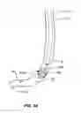 Fig. 06 - Method and apparatus for gastrointestinal tract ablation to achieve loss of persistent and/or recurrent excess body weight following a weight loss operation