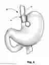 Fig. 02 - Bariatric device and method for recipient with altered anatomy
