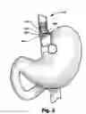 Fig. 06 - Bariatric device and method for recipient with altered anatomy