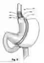 Fig. 07 - Bariatric device and method for recipient with altered anatomy