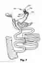Fig. 08 - Bariatric device and method for recipient with altered anatomy