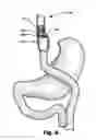 Fig. 09 - Bariatric device and method for recipient with altered anatomy