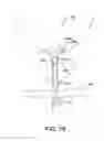 Fig. 09 - Pre-Positioned Anastomosis Device and Related Methods of Use