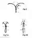 Fig. 07 - INTRAOCULAR CAPSULAR TENSION RINGS
