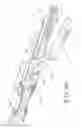 Fig. 49 - Anvil and cartridge alignment configuration for a circular stapler