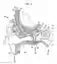 Fig. 02 - TEMPORARY ANCHOR FOR A HEARING PROSTHESIS