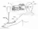 Fig. 01 - Methods of controlling magnetic nanoparticles to improve vascular flow