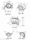 Fig. 06 - Assembly and method of implanting a heart assist system
