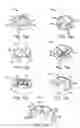 Fig. 08 - Assembly and method of implanting a heart assist system