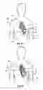 Fig. 31 - Assembly and method of implanting a heart assist system