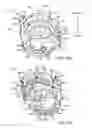 Fig. 45 - Assembly and method of implanting a heart assist system