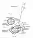 Fig. 04 - Intradural endoscope