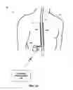 Fig. 02 - Therapy system including multiple posture sensors