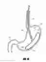 Fig. 02 - METHODS AND DEVICES FOR INTRAGASTRIC SUPPORT OF FUNCTIONAL OR PROSTHETIC GASTROINTESTINAL DEVICES
